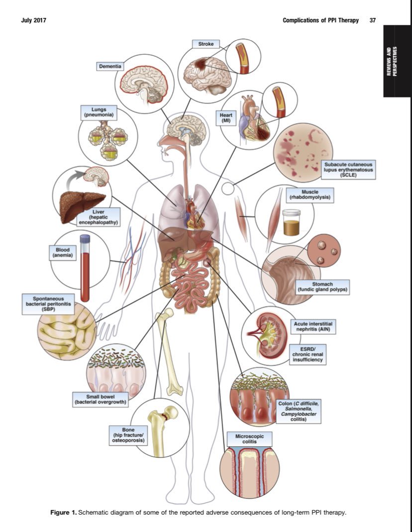 This is what I will show my patients to convince them to stopp their PPI 😉