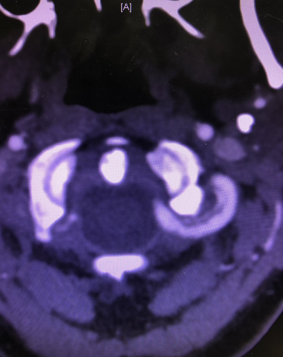 CharosT_va's tweet photo. To raise awareness! So how come chiropractors can get away with neck manipulation causing stroke? This person is 20 yo, now with bilateral vert dissection, bilateral cerebellar, occipital, thalamus infarcts and associated neurologic deficits! https://t.co/3MAsd2AlQW