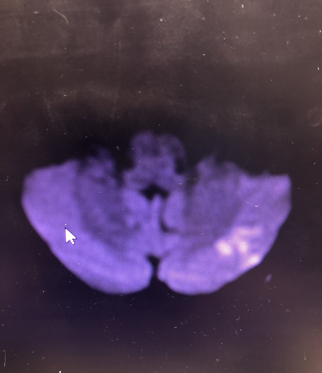 CharosT_va's tweet photo. To raise awareness! So how come chiropractors can get away with neck manipulation causing stroke? This person is 20 yo, now with bilateral vert dissection, bilateral cerebellar, occipital, thalamus infarcts and associated neurologic deficits! https://t.co/3MAsd2AlQW