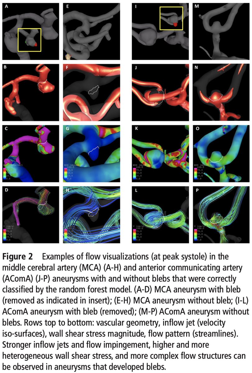cvsection's tweet photo. #Hemodynamic and #morphologic characteristics may help predict #aneurysm #bleb formation - #AI and #computational modeling may help determine at risk aneurysms
@JNIS_BMJ @svinsociety #endovascular
https://t.co/4CPnfAKFWm https://t.co/mkqHJc7eCw