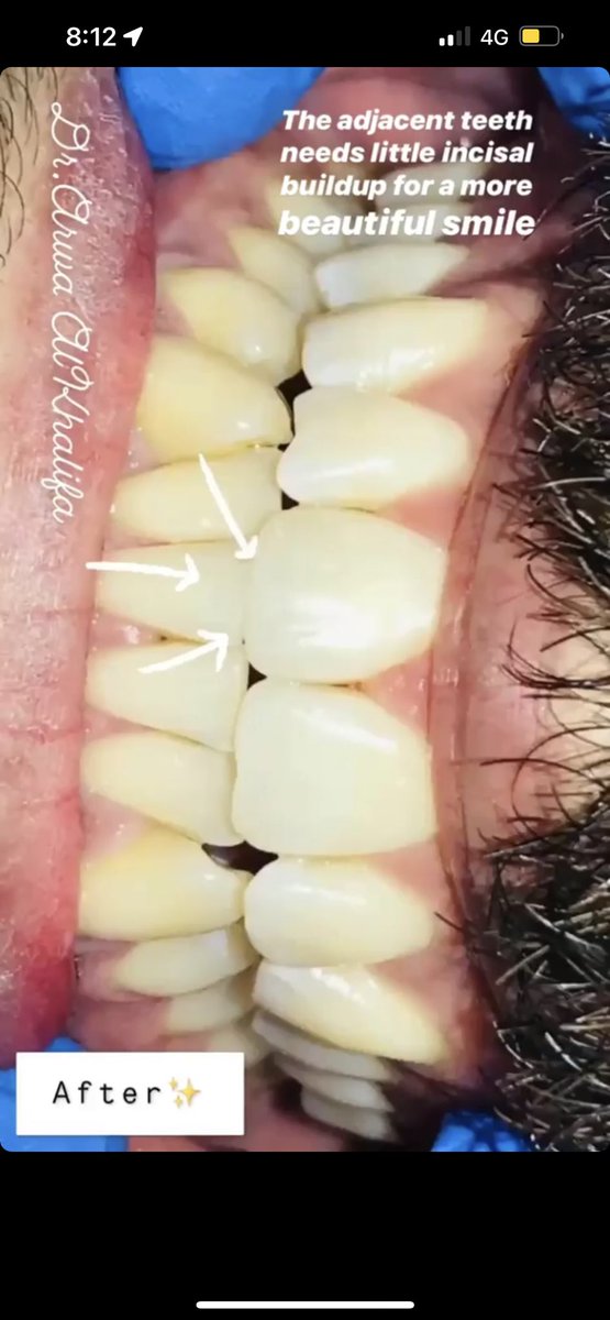 ArwaAk's tweet image. حشوه اماميه تجميليه ✨ حشوه صغيره تعمل فرق كبير في الابتسامه ✨ من شغلي .. #اسنان #حشوات_تجميليه