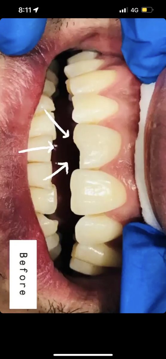 ArwaAk's tweet image. حشوه اماميه تجميليه ✨ حشوه صغيره تعمل فرق كبير في الابتسامه ✨ من شغلي .. #اسنان #حشوات_تجميليه