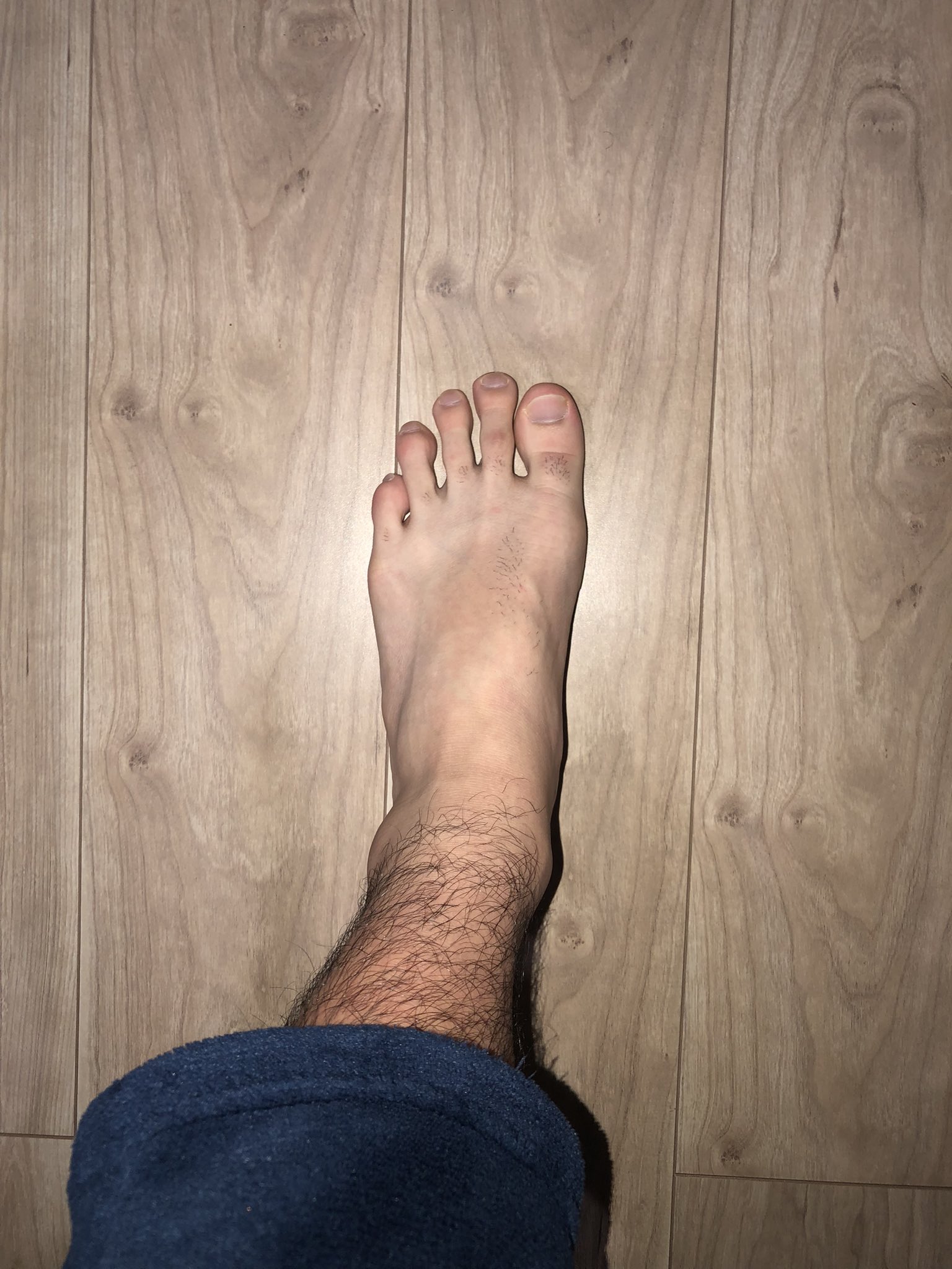 メンズ脱毛ライフ 足の甲 照射レベル6 4回目 レベル8 2回目 コメント わかる様なわからん 脱毛 脱毛器 ケノン ケノンレポ ケノン脱毛器 ケノン効果 メンズ脱毛 メンズ 全身脱毛 セルフ脱毛 足 足指 足の甲 指毛 指 T Co