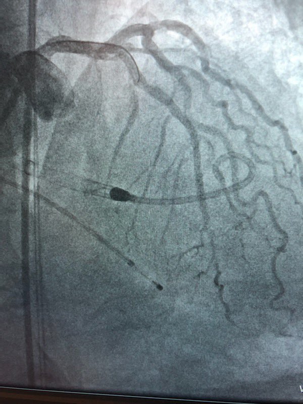 KeithNguyenSAIF's tweet photo. Rota Pella cto lad intervention. Left main and lcx bifurcating intervention. @SAIFSanAntonio https://t.co/VeBaKleeLX