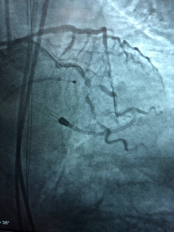 KeithNguyenSAIF's tweet photo. Rota Pella cto lad intervention. Left main and lcx bifurcating intervention. @SAIFSanAntonio https://t.co/VeBaKleeLX