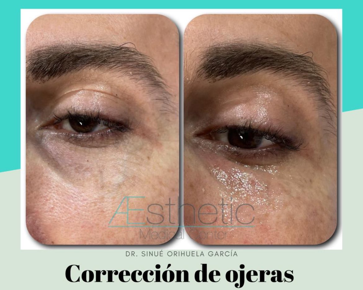 AestheticMC's tweet photo. La aparición de ojeras puede deberse a diversos factores: desvelos, tabaquismo, malos hábitos, estrés o la genética. 
El tratamiento de ojeras nos ayuda a disminuir la apariencia cansada y envejecida  que  dan las ojeras. 
#redensityII #teosyal #medicinaestetica #drsinuéorihuela https://t.co/b6HVgauVYf