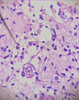 Demelas75938424's tweet photo. 40/M, RVI patient
Intracranial mass
Dont mind my arrow tngy
#pathtwitter
#cnspath
#infectiouspath https://t.co/G5xwWs3CVV