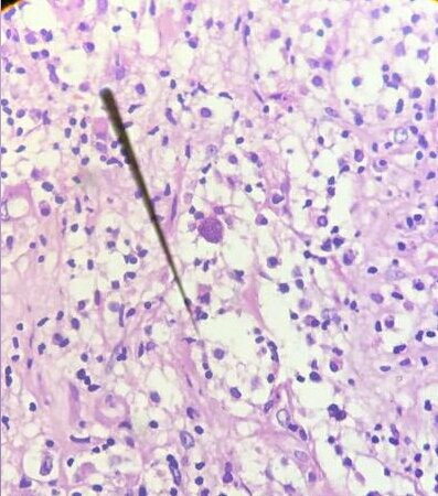 Demelas75938424's tweet photo. 40/M, RVI patient
Intracranial mass
Dont mind my arrow tngy
#pathtwitter
#cnspath
#infectiouspath https://t.co/G5xwWs3CVV