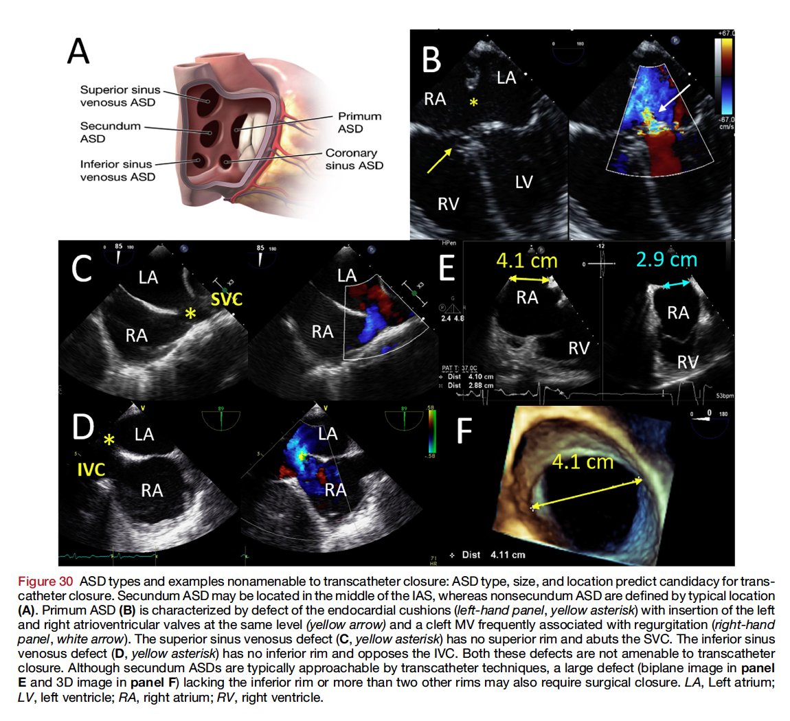 Edgardo Alania (@ed_alania) on Twitter photo 🔴Recommended Standards for the Performance of Transesophageal Echocardiographic Screening for Structural Heart Intervention <a href="/JournalASEcho/">JASE</a> <a href="/hahn_rt/">RTHahnMD</a> <a href="/robertomlang/">Roberto M Lang</a> <a href="/LucySafi/">Lucy</a> <a href="/LindaGillamMD/">Linda Gillam MD, MPH, MACC, FASE, FAHA, FESC</a> <a href="/ScaliaGreg/">Greg Scalia</a> <a href="/JaeKOh2/">Jae K. Oh</a> <a href="/OKhaliqueMD/">Omar Khalique</a> <a href="/nishath_quader/">Nishath Quader, MD</a> <a href="/EchoKen/">Ken Horton</a> <a href="/SLittleMD/">Stephen Little, MD</a> #CardioEd #Cardiology 🔴Recommended Standards for the Performance of Transesophageal Echocardiographic Screening for Structural Heart Intervention <a href="/JournalASEcho/">JASE</a> <a href="/hahn_rt/">RTHahnMD</a> <a href="/robertomlang/">Roberto M Lang</a> <a href="/LucySafi/">Lucy</a> <a href="/LindaGillamMD/">Linda Gillam MD, MPH, MACC, FASE, FAHA, FESC</a> <a href="/ScaliaGreg/">Greg Scalia</a> <a href="/JaeKOh2/">Jae K. Oh</a> <a href="/OKhaliqueMD/">Omar Khalique</a> <a href="/nishath_quader/">Nishath Quader, MD</a> <a href="/EchoKen/">Ken Horton</a> <a href="/SLittleMD/">Stephen Little, MD</a> #CardioEd #Cardiology