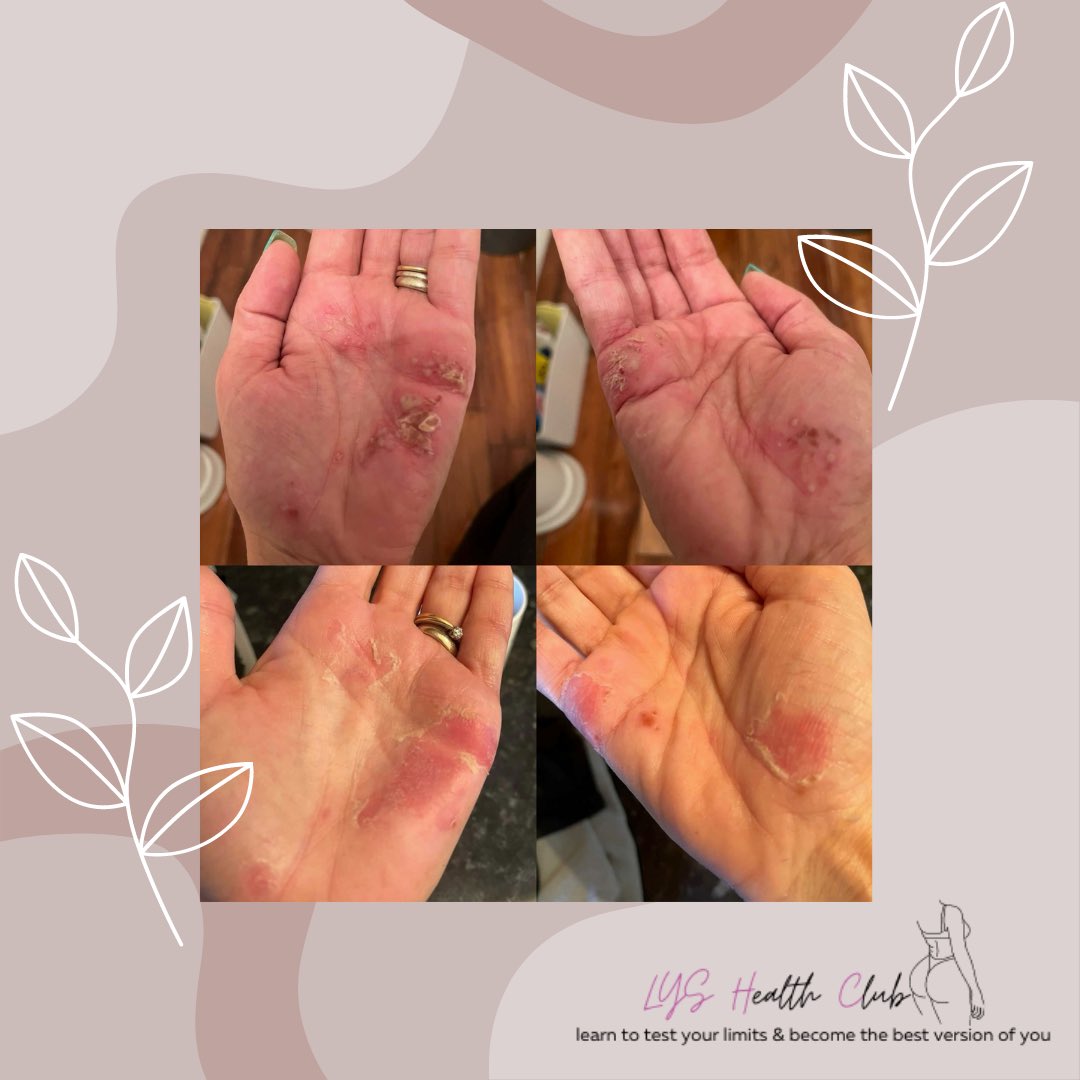 socialboomm's tweet photo. 𝗣𝗦𝗢𝗥𝗜𝗔𝗦𝗜𝗦 𝗣𝗥𝗢𝗚𝗥𝗘𝗦𝗦 💜💜✨✨

My lovely client Hayley started on our berry capsules just 2 months ago! She started them to help with hair growth, but as you can see they’re also healing her psoriasis on her hands! 😍💛 #LYSHEALTHCLUB https://t.co/xbp0Cl80Vz