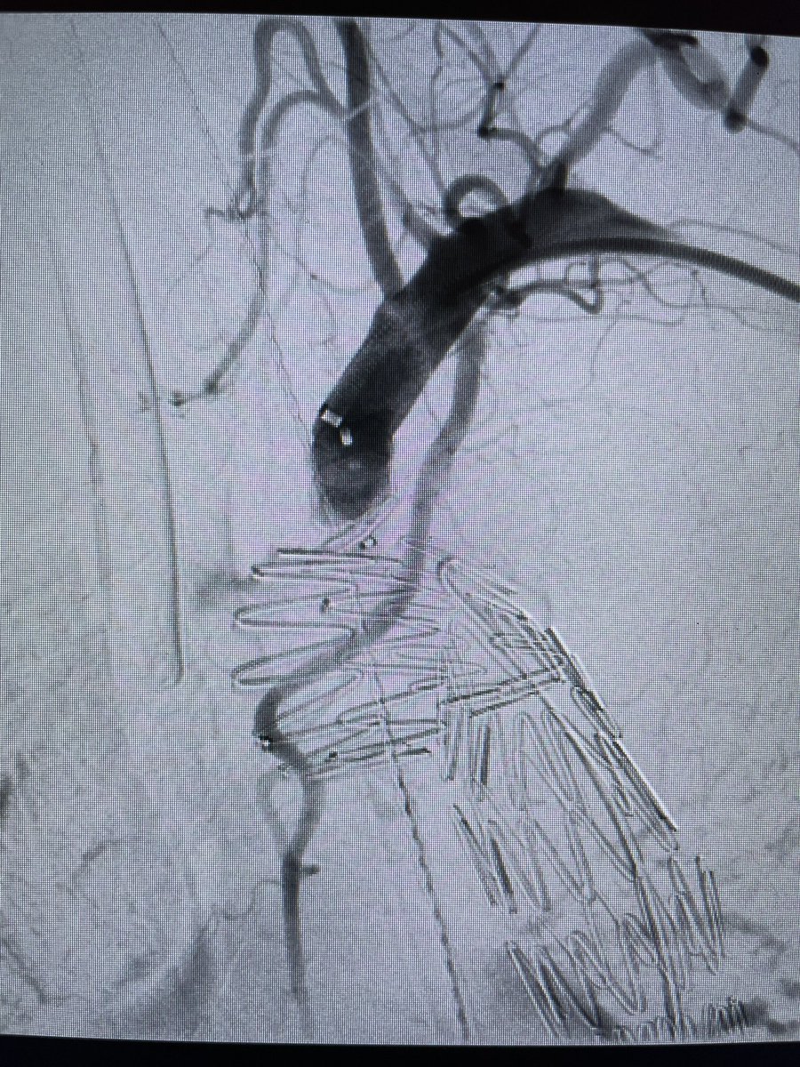 DanielMilesMD (@danielmilesmd) on Twitter photo Young man with chronic TBAD with new pain & high risk features - treated with L carotid-subclavian bypass and Zone II TEVAR and LSA Amplatzer 🤙🏼 <a href="/MoridzadehMD/">Rameen S. Moridzadeh, MD</a> <a href="/VSA_LLC/">Vascular Surgery Associates</a> <a href="/VascularSurgCS/">Cedars-Sinai Division of Vascular Surgery</a> #VascSurg #VascularTwitter #SoMe4Surgery #MedEd #aortaed Young man with chronic TBAD with new pain & high risk features - treated with L carotid-subclavian bypass and Zone II TEVAR and LSA Amplatzer 🤙🏼 <a href="/MoridzadehMD/">Rameen S. Moridzadeh, MD</a> <a href="/VSA_LLC/">Vascular Surgery Associates</a> <a href="/VascularSurgCS/">Cedars-Sinai Division of Vascular Surgery</a> #VascSurg #VascularTwitter #SoMe4Surgery #MedEd #aortaed