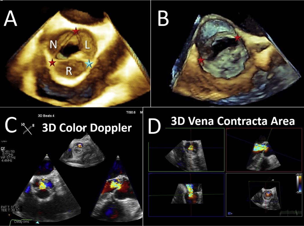 NadeenFaza's tweet photo. 💥Hot off the press! @JournalASEcho
Recommended Standards for the Performance of #TEE Screening for Structural Heart Intervention: From the @ASE360
👉https://t.co/o8FjDamLGP
#iecho #EchoFirst #Cardiotwitter #MedEd #TAVR #TEER #TreatTR #LAAO #IAS #SHDI #Cardioed https://t.co/6iOdSAgqKp