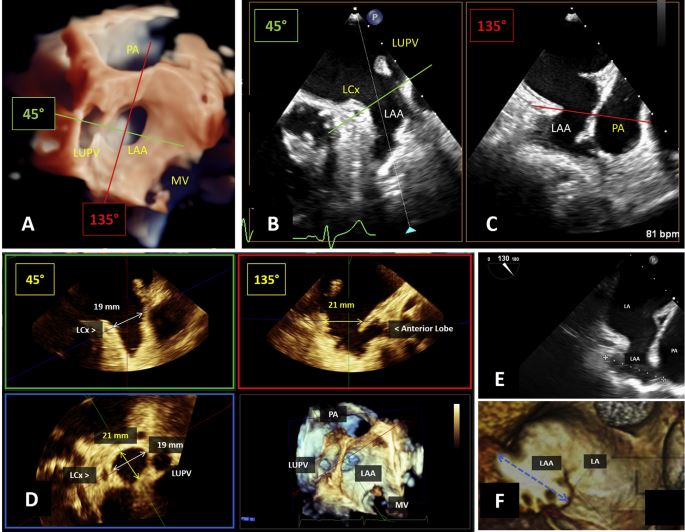 NadeenFaza's tweet photo. 💥Hot off the press! @JournalASEcho
Recommended Standards for the Performance of #TEE Screening for Structural Heart Intervention: From the @ASE360
👉https://t.co/o8FjDamLGP
#iecho #EchoFirst #Cardiotwitter #MedEd #TAVR #TEER #TreatTR #LAAO #IAS #SHDI #Cardioed https://t.co/6iOdSAgqKp