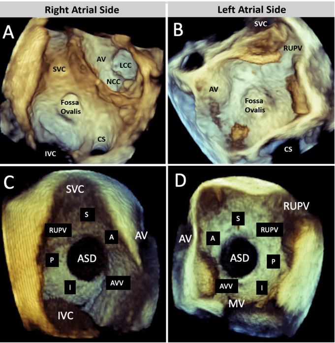 NadeenFaza's tweet photo. 💥Hot off the press! @JournalASEcho
Recommended Standards for the Performance of #TEE Screening for Structural Heart Intervention: From the @ASE360
👉https://t.co/o8FjDamLGP
#iecho #EchoFirst #Cardiotwitter #MedEd #TAVR #TEER #TreatTR #LAAO #IAS #SHDI #Cardioed https://t.co/6iOdSAgqKp