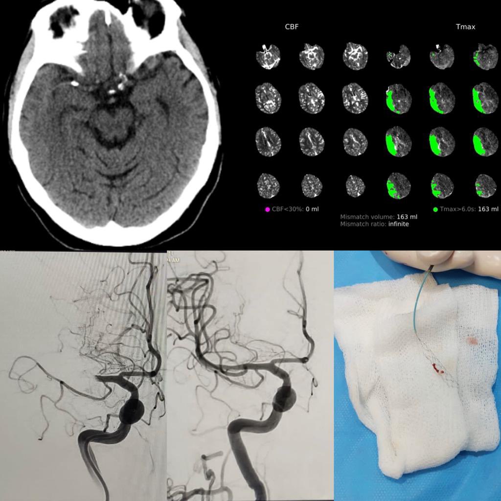 Neurología Vascular Fleni (@vascularfleni) on Twitter photo Hoy recibimos una paciente de 82 años, ultima vez vista asintomática 22:30 hs del 10/11. Ingreso 7:34 hs, mediante el <a href="/RapidAI/">RapidAI</a> determinamos la presencia de tejido salvable y stop M1 der. Continúa ⤵️
<a href="/interneurona/">INTERNEURONA</a> <a href="/DaianaDossi/">daiana.dossi</a> <a href="/J_Rosales_MD/">Julieta Rosales</a> <a href="/sfameriso/">sfameriso</a> <a href="/FleniOficial/">Fleni</a> Hoy recibimos una paciente de 82 años, ultima vez vista asintomática 22:30 hs del 10/11. Ingreso 7:34 hs, mediante el <a href="/RapidAI/">RapidAI</a> determinamos la presencia de tejido salvable y stop M1 der. Continúa ⤵️
<a href="/interneurona/">INTERNEURONA</a> <a href="/DaianaDossi/">daiana.dossi</a> <a href="/J_Rosales_MD/">Julieta Rosales</a> <a href="/sfameriso/">sfameriso</a> <a href="/FleniOficial/">Fleni</a>