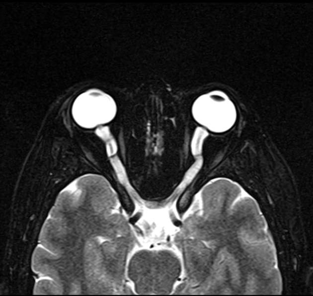 Q: 25yo female. What does this optic nerve sheath appearance indicate?
ANSWER: radiopaedia.org/cases/94468
#FOAMrad #FOAMed