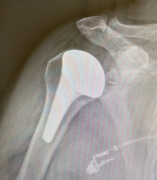 igniteortho's tweet photo. Congrats to designing surgeon Dr. Luke Austin on your first DePuy Synthes INHANCE Shoulder implantation, powered by @igniteortho https://t.co/CR0161zCIB