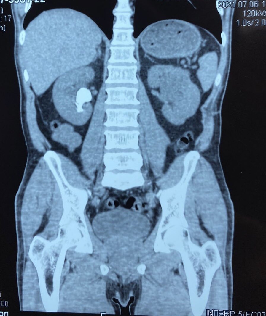 umaemac's tweet photo. Pielolitotomia ampliada derecha #LitiasisRenal #StoneFree @urovictore @Rocktor_Uro @Alejandro_Agc @ElvisSaguilan https://t.co/u8tTdPR8WT