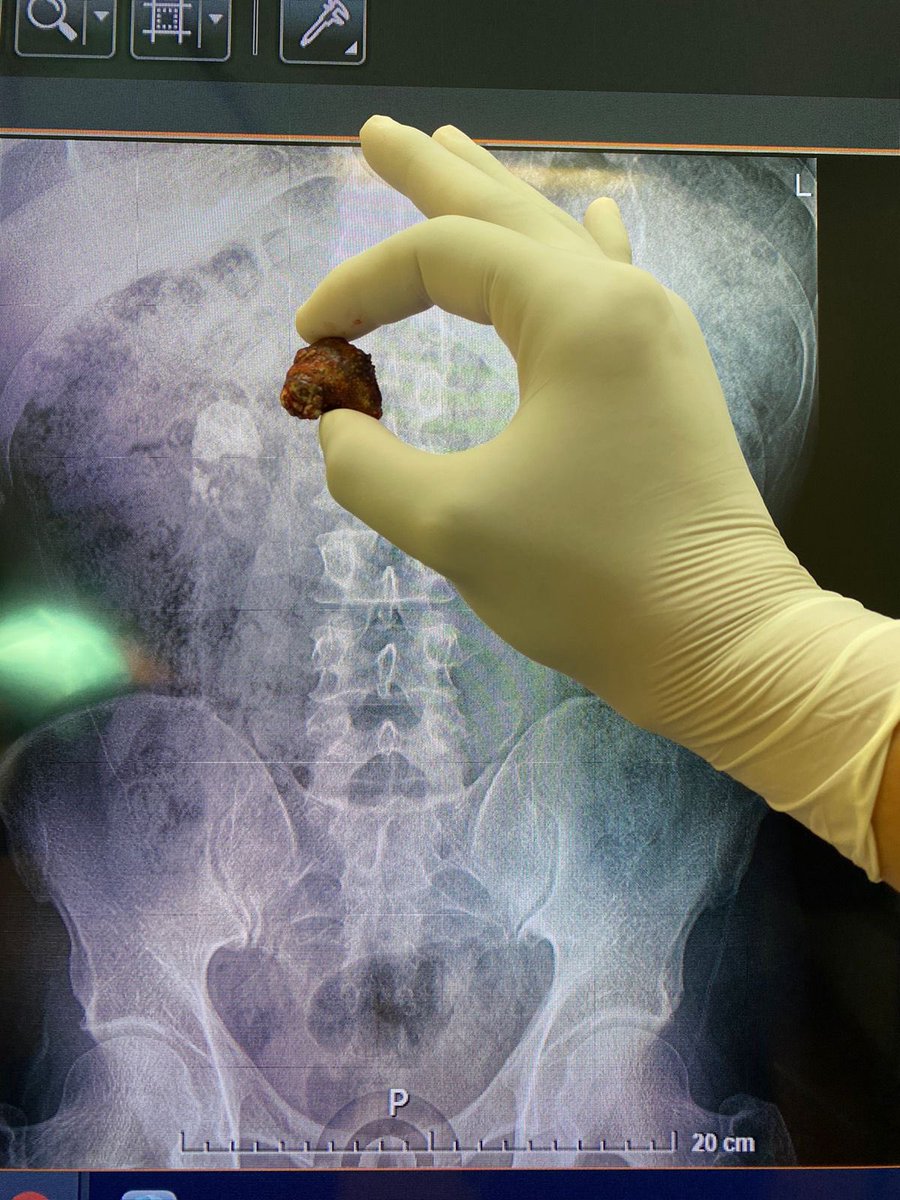 umaemac's tweet photo. Pielolitotomia ampliada derecha #LitiasisRenal #StoneFree @urovictore @Rocktor_Uro @Alejandro_Agc @ElvisSaguilan https://t.co/u8tTdPR8WT