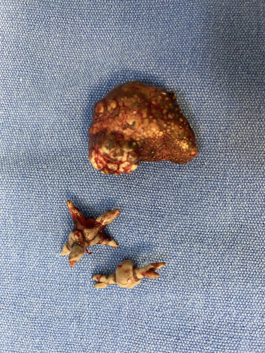 umaemac's tweet photo. Pielolitotomia ampliada derecha #LitiasisRenal #StoneFree @urovictore @Rocktor_Uro @Alejandro_Agc @ElvisSaguilan https://t.co/u8tTdPR8WT