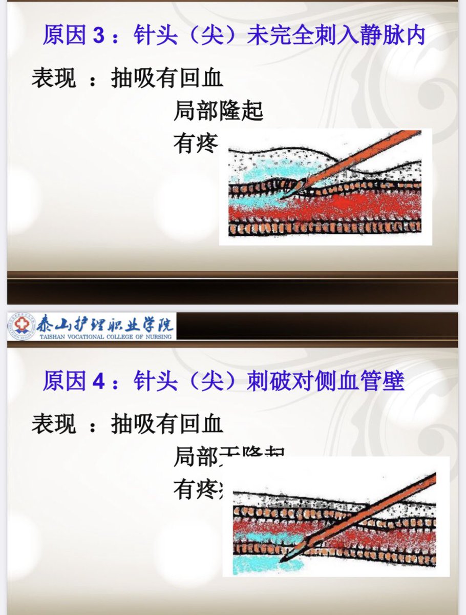 「為什麼我有回到血 卻還是漏針？」 比較常見的原因 是附圖最末張那兩種情況