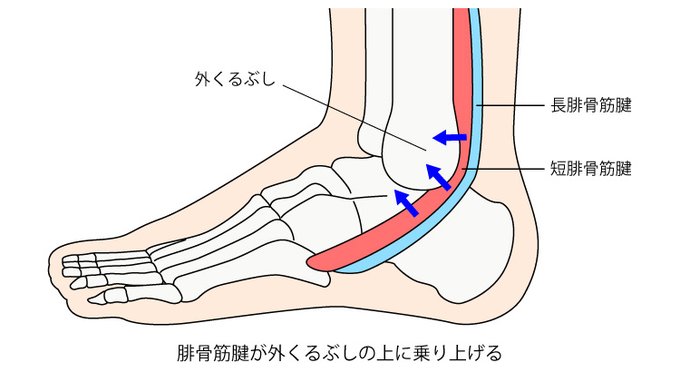 アキレス腱のtwitterイラスト検索結果 アキレス腱のtwitterイラスト検索結果