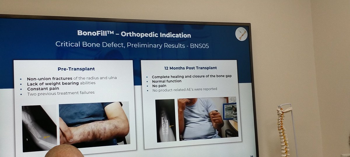 KKLdeFrance's tweet photo. En visite à #Haifa en #Israel de la société #BonusBiogroup, société de biotechnologie qui vient de trouver un traitement expérimental, #MesenCure contre les formes graves de la #COVID19 et travaille sur le traitement #BonoFill pour la régénération des os du corps humain. https://t.co/4AgraqEDDm