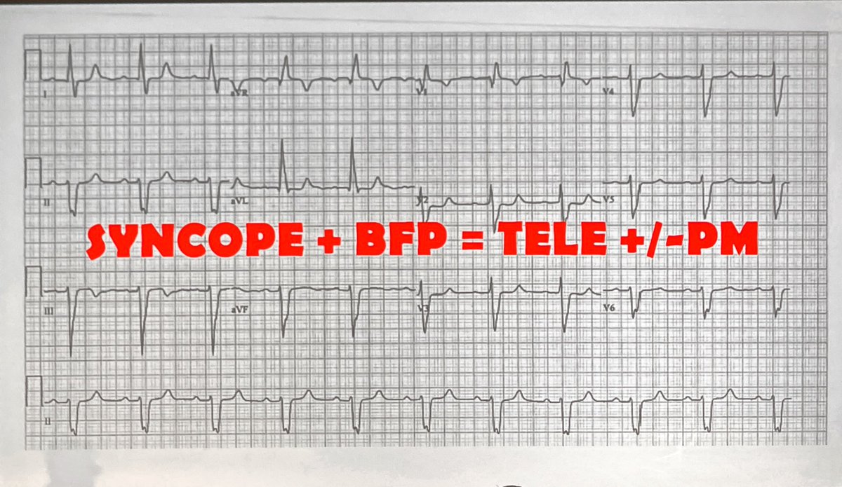 rob_cosentini's tweet photo. Syncope w/ @davidcarr333
Exertional:
Suspect HOCM if LVH without HTN/aortic stenosis
Always look for hidden ECG abnormalities
1 Blocks, from bifascicular on
2 Delta wave
2 Brugada, worsens with fever
3 Epsilon wave in ARVC
4 Long QT
WOBBLER mnemonic
 #eusem21 @EuropSocEM @EusemY https://t.co/MguU9ueWbY