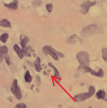 AnthonyLieuMD's tweet photo. Guess the disease

1. 2-year history of "B-symptoms"
2. Extensive travel history
3. Bilateral adrenal masses

https://t.co/KmWWrzAfWV for the answer

Biopsy revealing : https://t.co/zJLnisHCPF