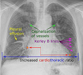 This CXR appearance is seen in ?