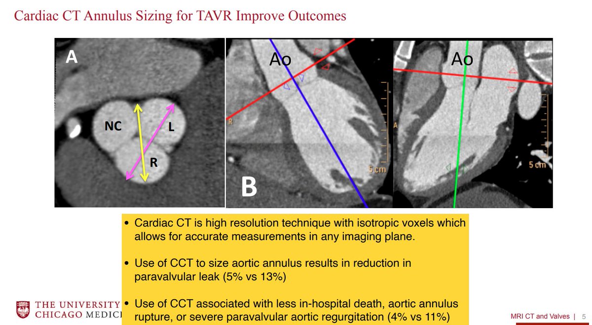 ASE360's tweet photo. @AmitRPatelMD continues with #ValvularHeartDisease The Important Contributions of #CardiacCT and #CardiacMRI
#EchoFlorida #MRI #MRIImaging https://t.co/1OdPzv6Auo
