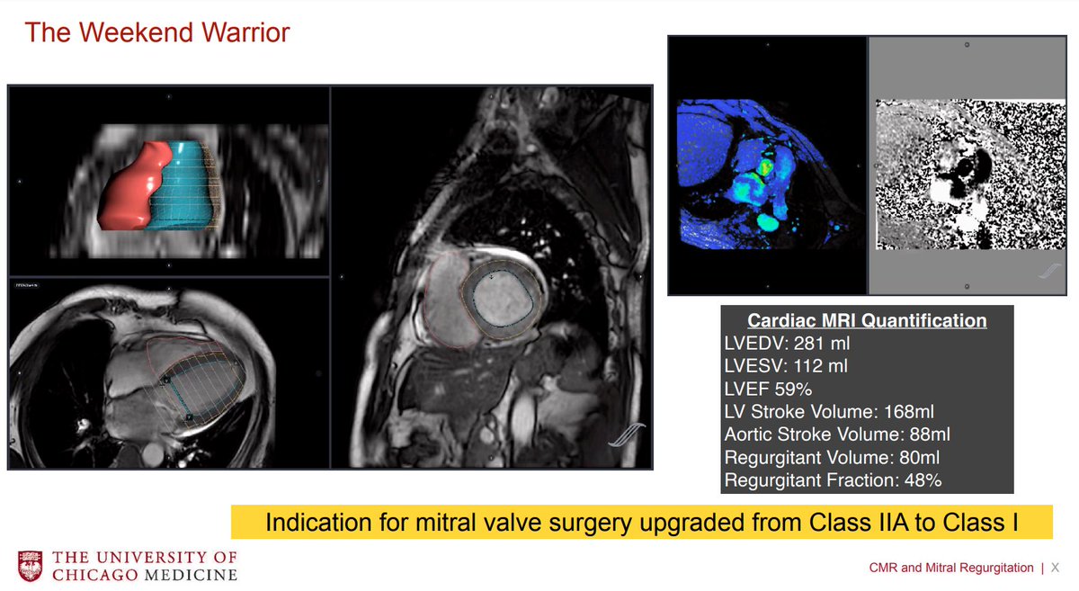 ASE360's tweet photo. @AmitRPatelMD continues with #ValvularHeartDisease The Important Contributions of #CardiacCT and #CardiacMRI
#EchoFlorida #MRI #MRIImaging https://t.co/1OdPzv6Auo