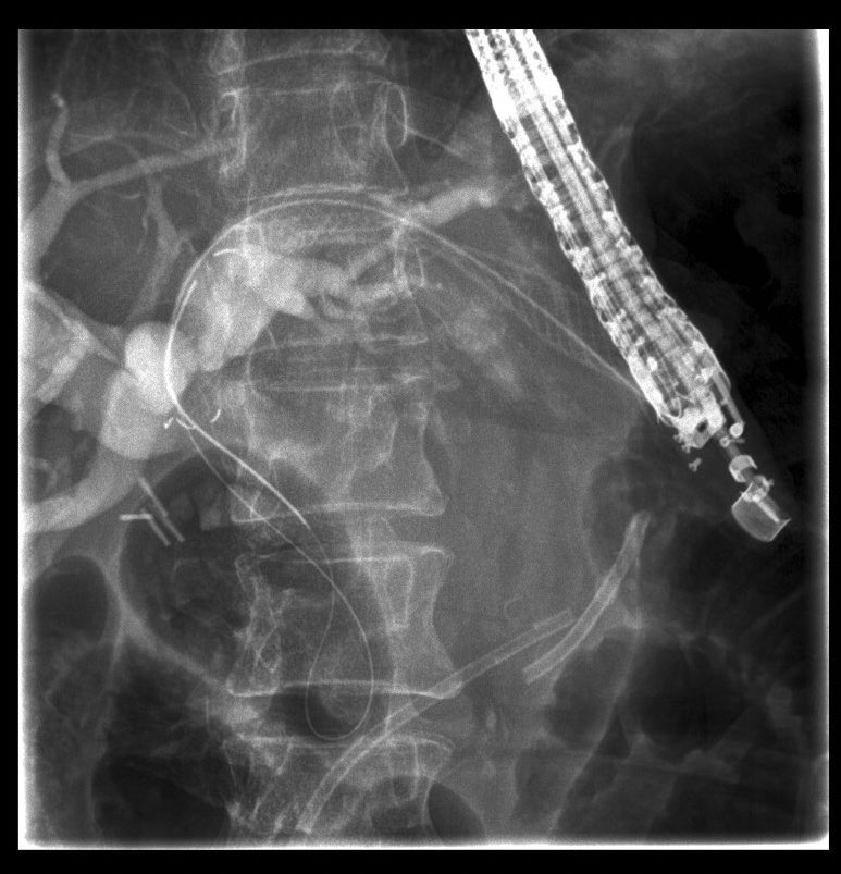 renzopc77's tweet photo. EUS guided biliary drainage : hepaticogastrostomy using dedicated stent (GIOBOR stent)in a patient with pancreatic cancer and duodenal stenosis. #EUS #GIOBOR  @taewoongmedical #pancreas #PancreaticCancer https://t.co/sV3hFD8M1s