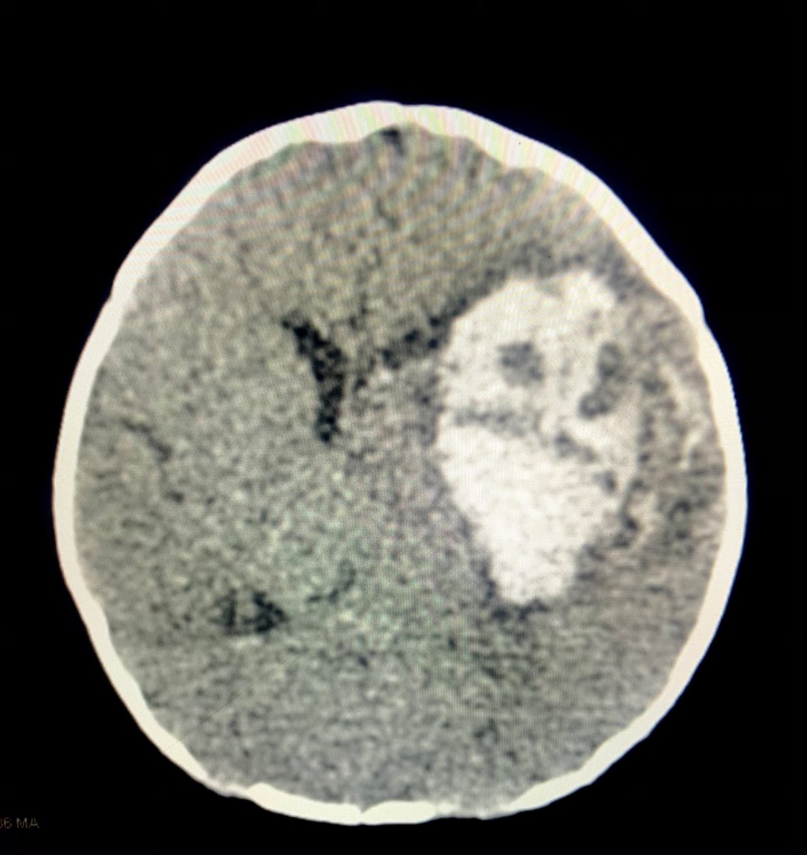 MariaParekh's tweet photo. #neurotwitter #Neurology #Neurosurgery #NeuroTwitterNetwork
#halloween2021 #Halloween #Hallowstream
Ghosts, zombies, vampires and monsters don’t scare me. But this does..
PS: For educational purposes only. Pictures are ©. Please do not copy https://t.co/4ktrUEUtqv