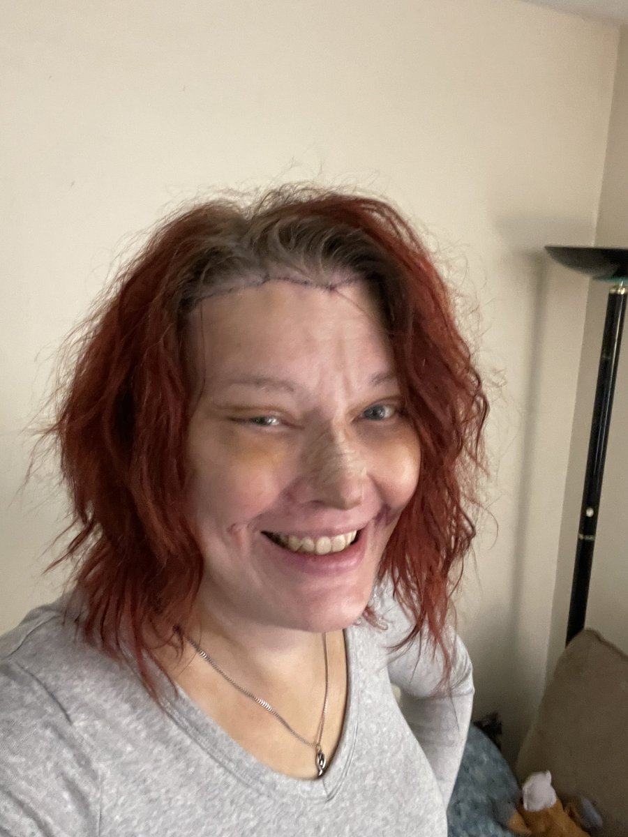 YuusuiWaltz's tweet photo. I am healing very well. Still lots of swelling and bruising, but I’m starting to feel so good about my self! #fgcs #drpang #mountsinai https://t.co/V9TCwuJCLt