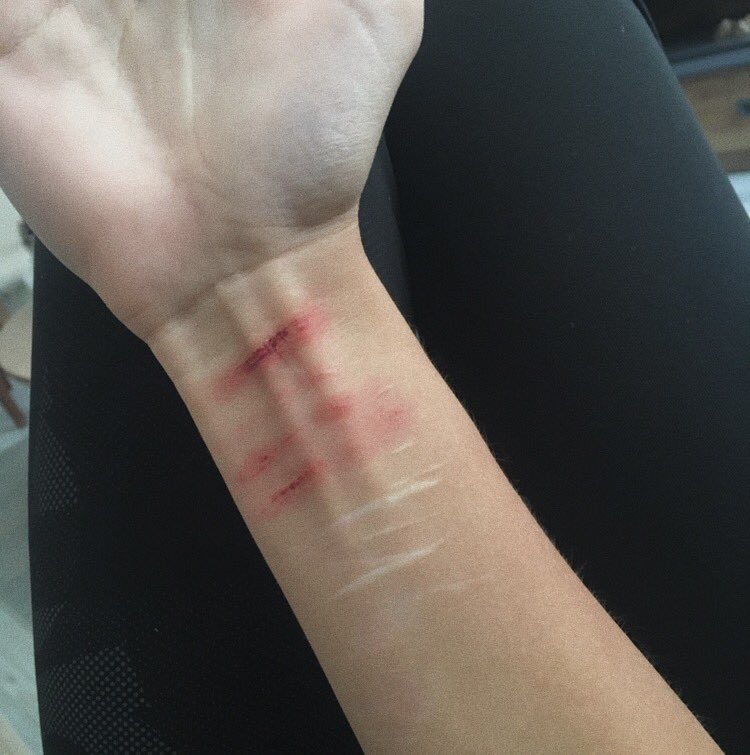 seiferthunt's tweet photo. tw | self h@rm, arm check https://t.co/fgbz8AEEsa
