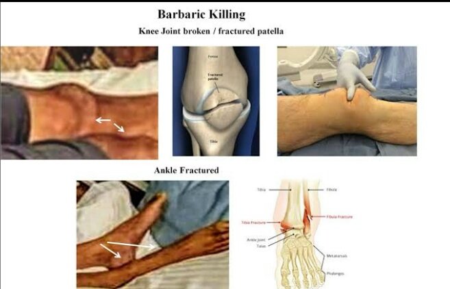 sushfanseg's tweet photo. Bruises on Face
Legs were broken 
Ligature &amp; Deep Needle marks
Body Swollen and heavy
Lips were turning black
Pale body

Are all these Injuries came from Suicide❓ 

@ips_nupurprasad 
@PMOIndia
Injuries Scream SSR Murder https://t.co/DDqp9BMsQi