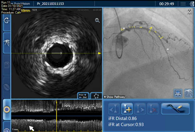 Saar_Minha's tweet photo. Tri-registration (angio+ivus+iFR) of a 45YOM homeless (not taking meds). UA, ISR@LAD. Pre: ifr diffuse LAD dis step-up@stent. IVUS- underexpanded. Post cutting+DCB resulted in iFR=0.92. @IlyaLitovchik @AsherElad @sbrugaletta @PCRonline @Philips @hect2701 https://t.co/VPF7ZQb4ji