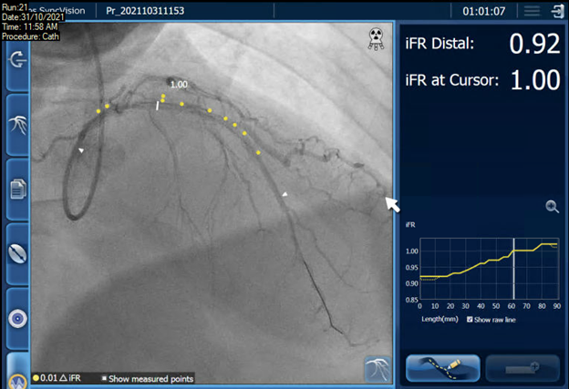 Saar_Minha's tweet photo. Tri-registration (angio+ivus+iFR) of a 45YOM homeless (not taking meds). UA, ISR@LAD. Pre: ifr diffuse LAD dis step-up@stent. IVUS- underexpanded. Post cutting+DCB resulted in iFR=0.92. @IlyaLitovchik @AsherElad @sbrugaletta @PCRonline @Philips @hect2701 https://t.co/VPF7ZQb4ji
