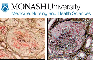 We are employing 2 Postdocs🔬 to help understand immune kidney diseases!
Our focus is autoimmune vasculitis, as well as the nexus between infections and kidney disease.
FACS, immune techniques and experimental model experience would be great!
To apply tinyurl.com/eyr82s7h