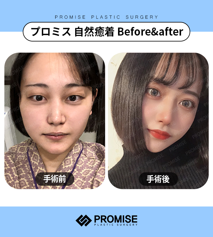promiseplasty's tweet photo. 💖プロミスリツイートイベント💖

当ツイートをリツイートするだけで最大25万ウォン分の施術券をゲットできます💡
イベントは11月30日までの期間限定となっています❕

プロミスが気になる方はぜひリツイートしてください🥰

LINE公式アカウント👉https://t.co/IepLyWFYpm
＃RTイベント https://t.co/sKpKHyslYx