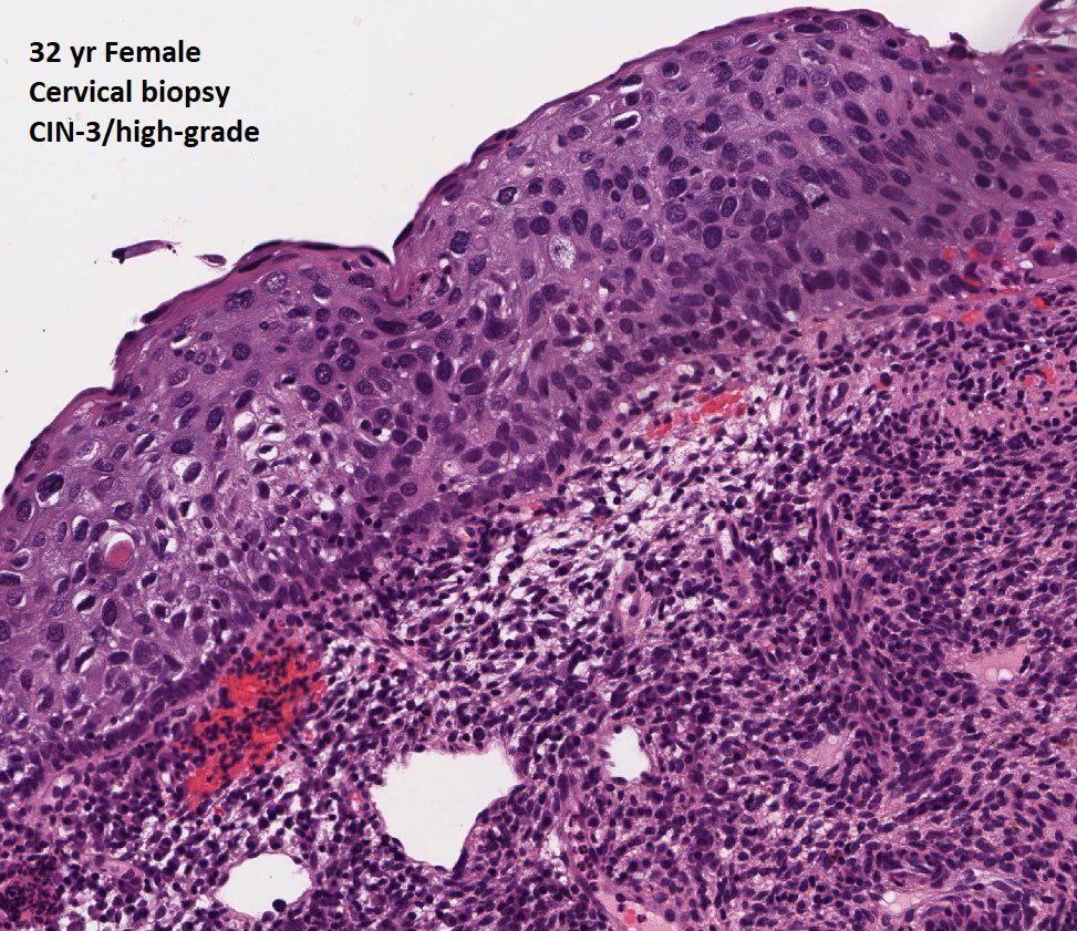 DrTravisBrown's tweet photo. Histology/micro flash card

Cervical cancer

Risk factors: HPV infection, smoking, age, number of sexual partners
Incidence population 

~60% HPV-16
10-15% HPV-18

60% of pts with CIN-1/low-grade regress to normal after 1 year

Prognosis is dependent upon severity

#PathTwitter https://t.co/nlQzPvtd6S