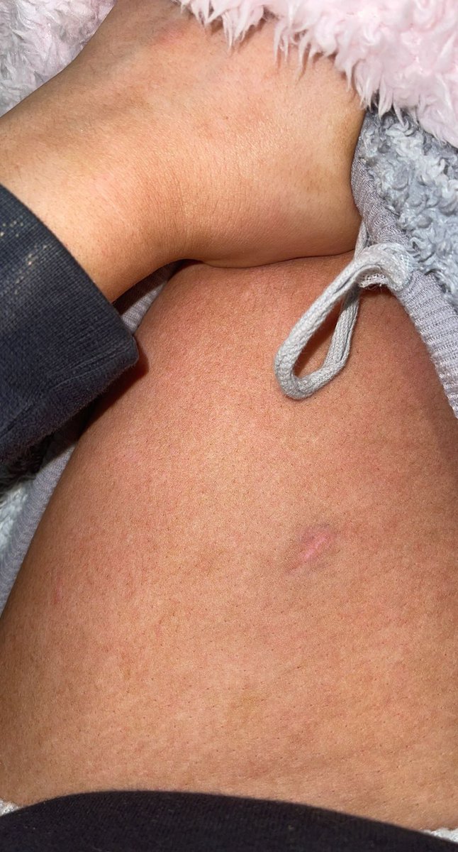 Georgiashand_'s tweet photo. 📍revolution Aberdeen 
Last night I was spiked in revolution by an injection luckily enough I was surrounded by the best people to care for me and to take me to hospital to receive the right treatment, disgusting that girls have to go out in constant fear of this happening. https://t.co/PEdNPnBQTj