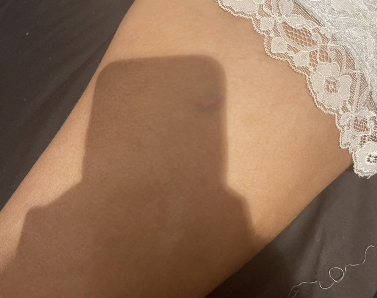 📍revolution Aberdeen 
Last night I was spiked in revolution by an injection luckily enough I was surrounded by the best people to care for me and to take me to hospital to receive the right treatment, disgusting that girls have to go out in constant fear of this happening.