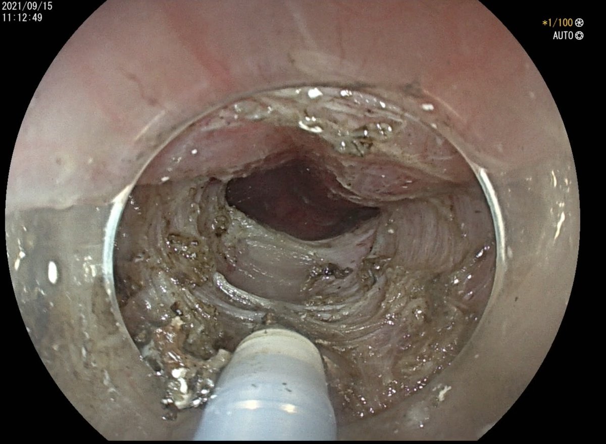 DIGESTIVE ENDOSCOPY tweet media