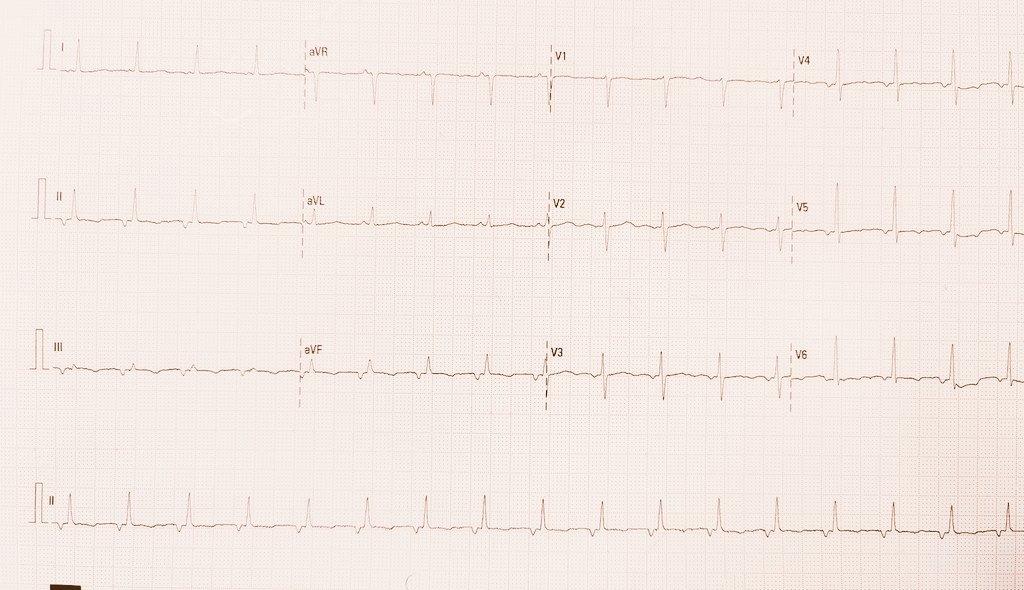 55y female presented with ACS , echo - normal , what is the rhythm??#cardiotwitter #ECG <a href="/UlhasDr/">Dr Ulhas Pandurangi</a> <a href="/mahishasur/">❤</a> <a href="/The_Nanashi_O/">Nanashī🫀</a> <a href="/MaruanCarlos/">Maruan C Chabbar</a> <a href="/ecgrhythms/">Arnel Carmona</a> <a href="/SchakrabartiEP/">Shanta Chakrabarti</a> <a href="/manak_18/">Deepak Padmanabhan</a>