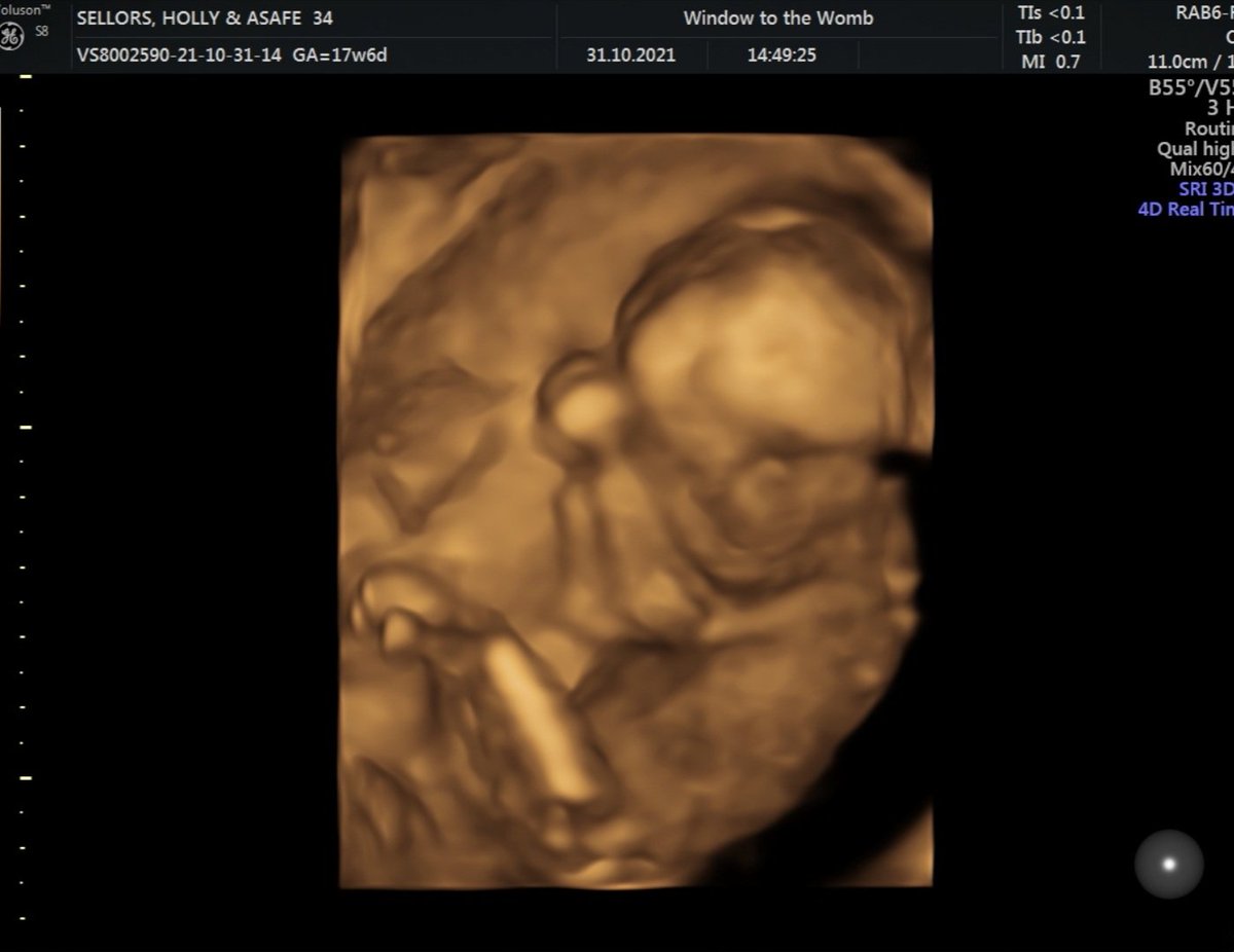 projectlumino's tweet photo. Happy Halloween from my lil pumpkins ❤🎃🎃❤
Yesterday we found out Rio will be having a little sister!!!! 😍😍😍😍 She is all well and we are thrilled 🥰 @windowtothewomb
#baby #halloween #18weeks #ultrasound #4dscan #pregnant https://t.co/Ndqs1j1Rt3