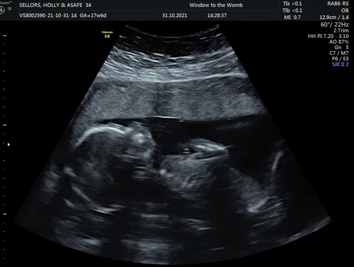 projectlumino's tweet photo. Happy Halloween from my lil pumpkins ❤🎃🎃❤
Yesterday we found out Rio will be having a little sister!!!! 😍😍😍😍 She is all well and we are thrilled 🥰 @windowtothewomb
#baby #halloween #18weeks #ultrasound #4dscan #pregnant https://t.co/Ndqs1j1Rt3
