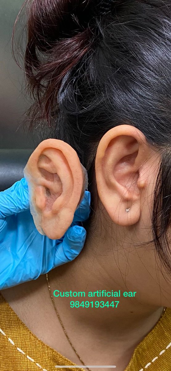 KULDEEPRAIZADA's tweet photo. Restoration of ear with ear prosthesis #earprosthesis #microtia #nternationalprostheticeyecenter #earcancer https://t.co/mrD3Cl9EWN