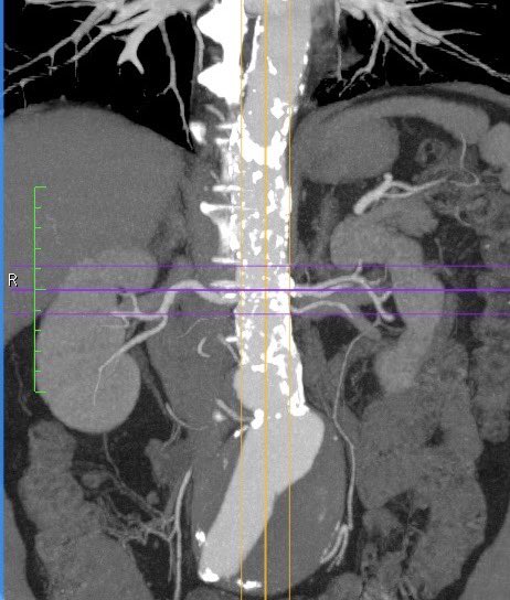 lbncbma's tweet photo. Aneurisma de Aorta com Oclusão De Artéria Ilíaca.
Tratamento com Endoprotese e Ponte Cruzada.
#endovascularsurgery #PTA #criticallimbIschemia #thinkaorta  #medtwitter
#aneurysm #practicemakesperfect #vasculartraining #hybridroom #teamvascular #revascularization https://t.co/HXlvuGZj4k
